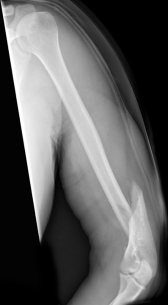 Fratura do úmero distal Fratura do úmero distal